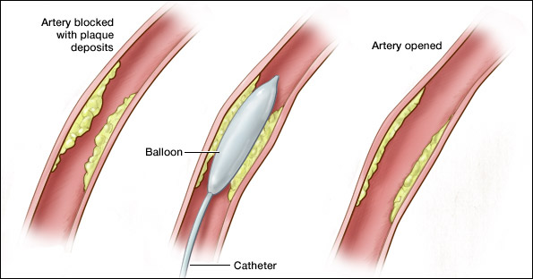 This is proper guide to balloon angioplasty by Dr Arora and Team